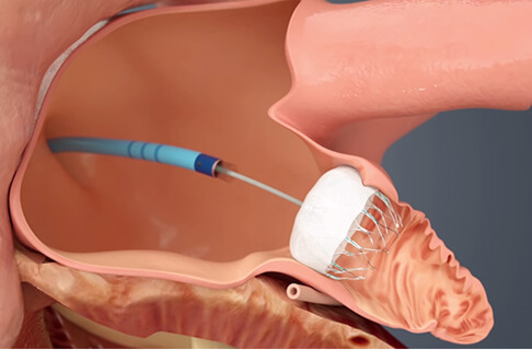 Reducción del riesgo de accidente cerebrovascular: el implante Watchman para pacientes con fibrilación auricular